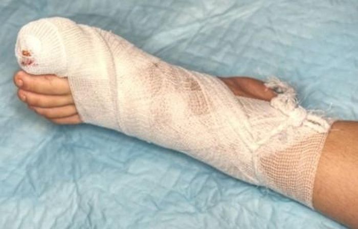Anh Trần suýt phải cắt cụt chi vì lạm dụng thuốc kháng sinh.
