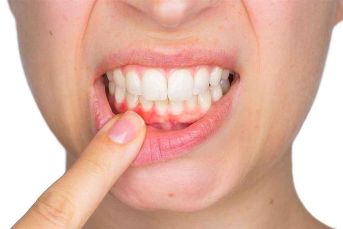 Tụt nướu có thể xảy ra ở cả hai hàm với bất cứ vị trí răng nào. Nguồn ảnh: Internet