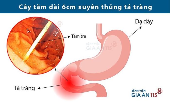 Cây tăm dài 6cm xuyên thủng tá tràng người bệnh. Ảnh: BV.