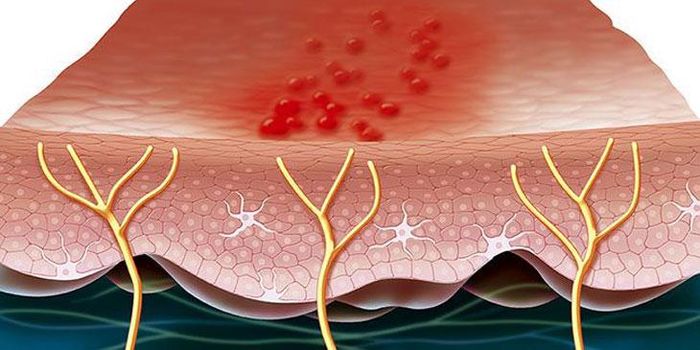 Đau sau zona thần kinh là một biến chứng thường gặp, gây khó chịu và ảnh hưởng đến chất lượng sống của bệnh nhân.