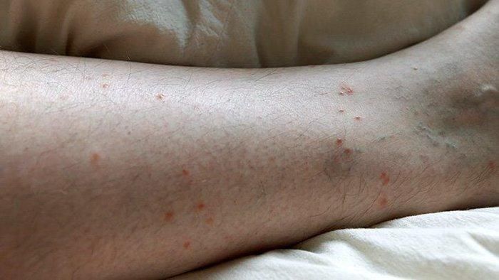 Vết bọ chét cắn thường xuất hiện theo nhóm ba hoặc bốn vết, ngứa, nổi mề đay (Ảnh: Everydayhealth)