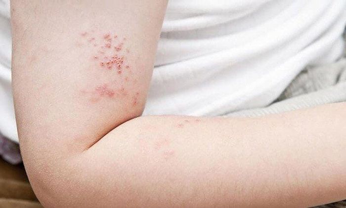 Zona thần kinh là kết quả của sự tái hoạt động của virus thủy đậu.