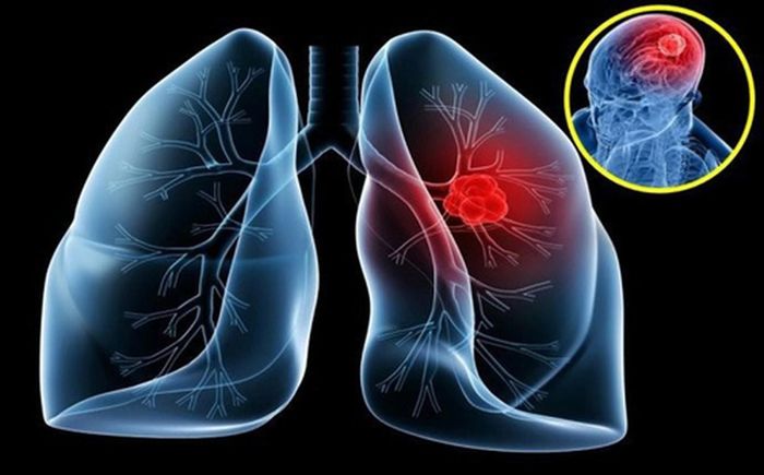 Một số trường hợp, khối u phổi chèn ép lên tĩnh mạch chủ sẽ gây ra hiện tượng đau đầu. Đây là loại tĩnh mạch lớn, đóng vai trò vận chuyển máu từ phần trên của cơ thể về tim. Sức ép của khối u sẽ khiến bệnh nhân bị đau đầu thường xuyên.