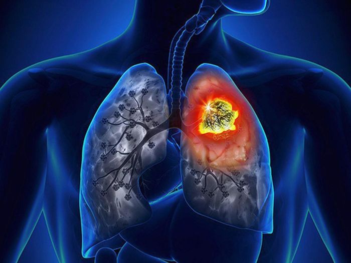 Đau được coi là triệu chứng phổ biến nhất của ung thư phổi. Theo Lungcancer.net, khoảng 75% bệnh nhân ung thư có dấu hiệu đau nhức. Có ba nguyên nhân phổ biến gây đau ở bệnh nhân ung thư phổi. Thứ nhất, đau do di căn của ung thư phổi đến xương, chiếm khoảng 34% cơn đau do ung thư phổi.