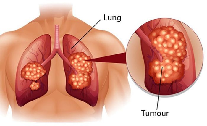 Thứ hai, đau bắt nguồn từ sự hiện diện khối u Pancoast, nằm ở đỉnh phổi gần với dây thần kinh đám rối cánh tay và dây thần kinh giao cảm cổ, chiếm khoảng 31% cơn đau do ung thư phổi. Cuối cùng, nguyên nhân đau bắt nguồn do tế bào ung thư di căn vào thành ngực, chiếm khoảng 21% cơn đau do ung thư phổi.