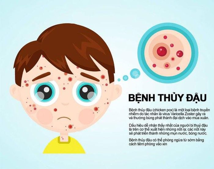Bệnh thủy đậu là do virus Varicella-zoster gây ra