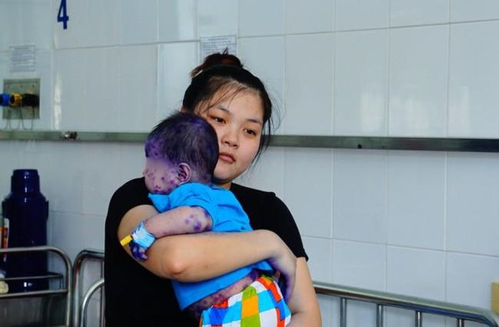 Nhiều trẻ bị thủy đậu. Ảnh: TTXVN
