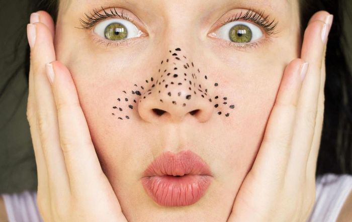 Trị mụn đầu đen: Để trị mụn đầu đen, bạn dùng chanh hòa trong nước thoa lên mặt đã được rửa sạch. Sau khi đợi khoảng 5 – 10 phút, massage nhẹ nhàng. Cuối cùng, rửa mặt lại bằng nước lạnh. Ảnh minh họa