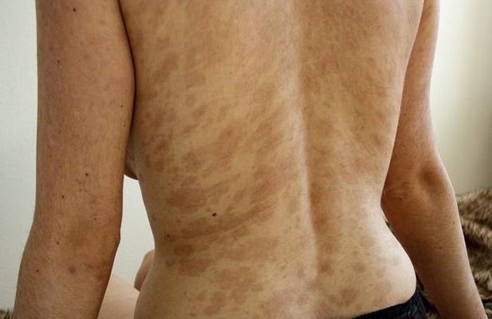Vùng da bị tổn thương trên cơ thể bệnh nhân. Ảnh: BVCC.