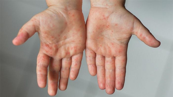 Tay chân miệng xảy ra phổ biến với trẻ dưới 5 tuổi. Ảnh: Raisingchildrennetwork.