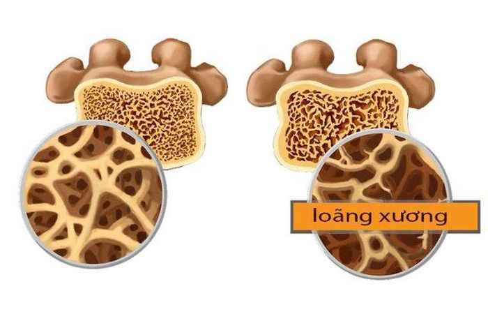 Cách đơn giản và an toàn nhất là bổ sung canxi bằng các thực phẩm hàng ngày.