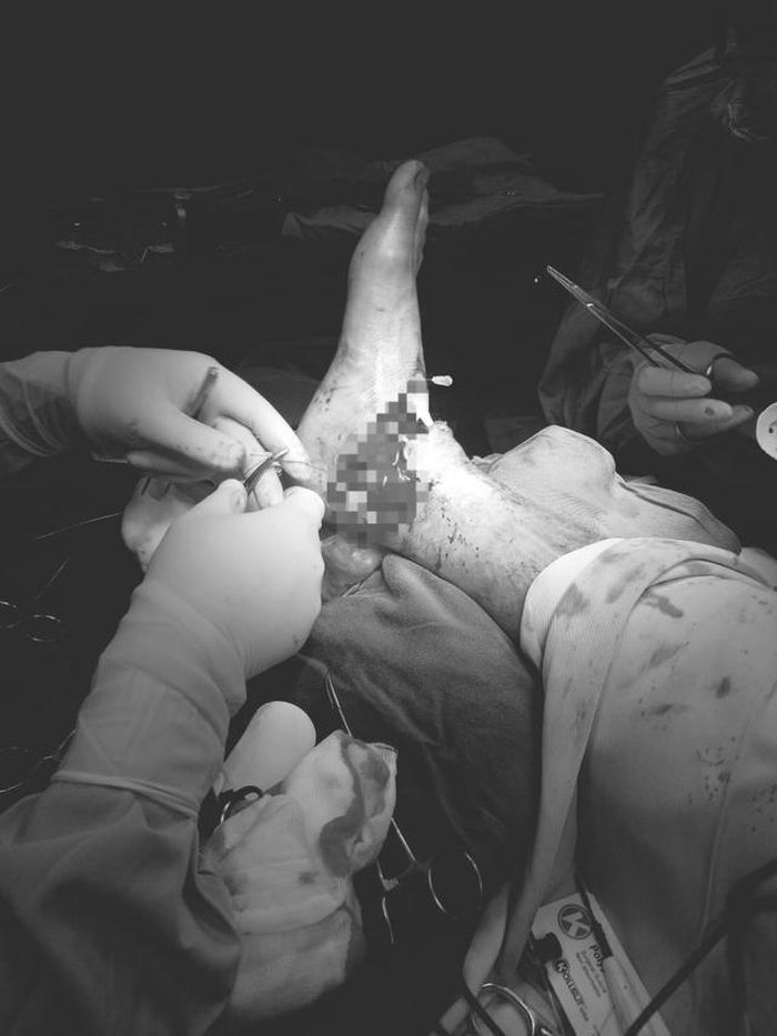Ekip liên chuyên khoa của bệnh viện thực hiện phẫu thuật nối liền chi bị đứt.
