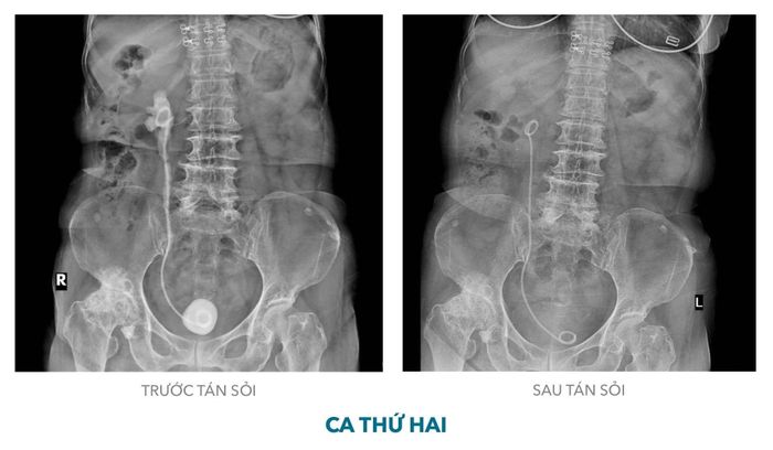  Bệnh nhân được tán sỏi qua 3 chặng và phục hồi bình thường sau 3 ngày. Ảnh: BVCC. 