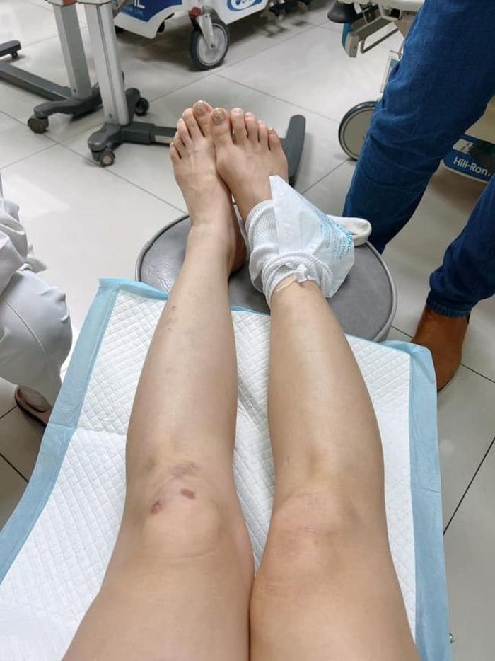 Chân Lan Phương khi mới bị ngã