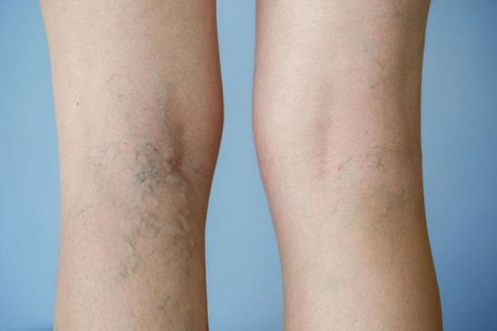 Suy giãn tĩnh mạch chân thường xảy ra ở người cao tuổi.