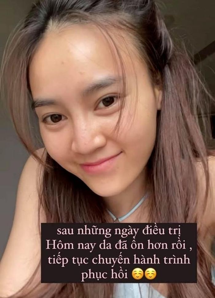 Lan Ngọc chăm sóc da mặt kỹ lưỡng khi bị nổi mụn. Ảnh: FBNV