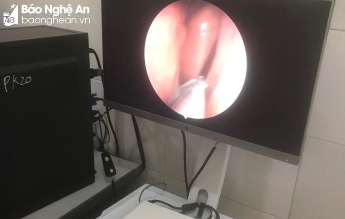 Hình ảnh con vắt cư trú trong khoang mũi bệnh nhân. Ảnh: Đình Hào