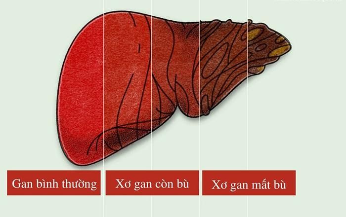 Hình ảnh gan bình thường và xơ gan