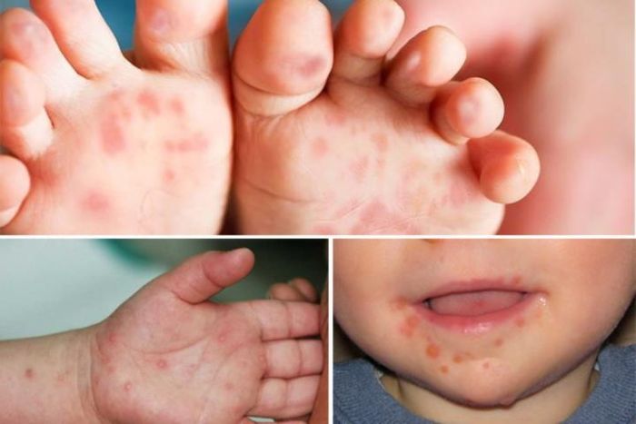 Bệnh tay chân miệng có thể gây ra những tổn thương nghiêm trọng và biến chứng có thể tử vong nếu không được xử lý kịp thời. (Ảnh minh họa)
