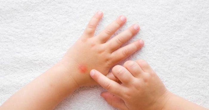Mẹo xử lý khi bị muỗi đốt
