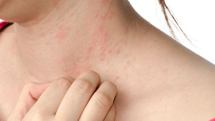Côn trùng đốt thường viêm tấy đỏ, giai đoạn đầu có thể quan sát thấy vết đốt ở giữa tổn thương.
