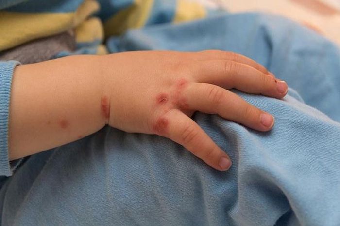 Bệnh tay chân miệng ảnh hưởng nghiêm trọng đến sức khỏe (Ảnh minh họa)