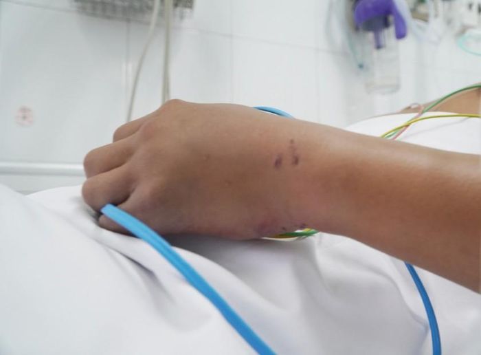  Bệnh nhân bị rắn hổ chúa cắn, phải truyền 10 lọ huyết thanh kháng nọc rắn đa giá mới giúp bệnh nhân vượt qua cơn nguy kịch.
