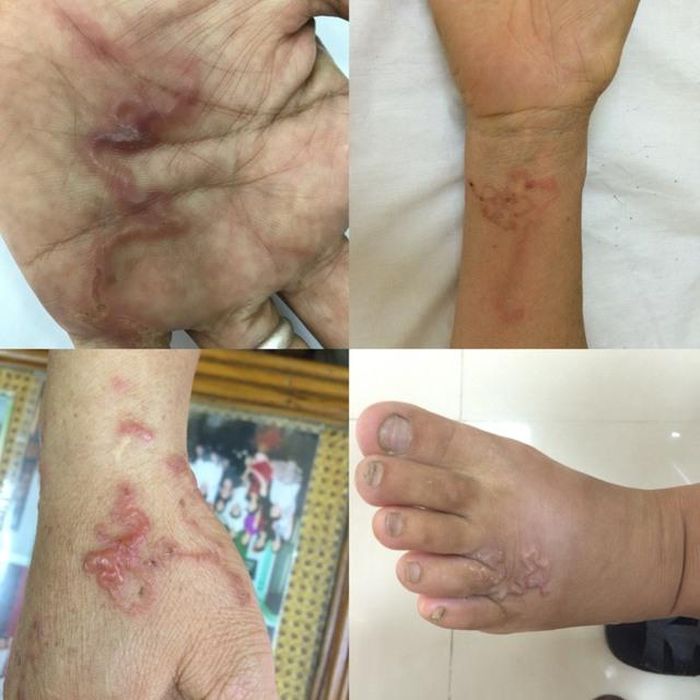 Hình ảnh ấu trùng di chuyển dưới da người.