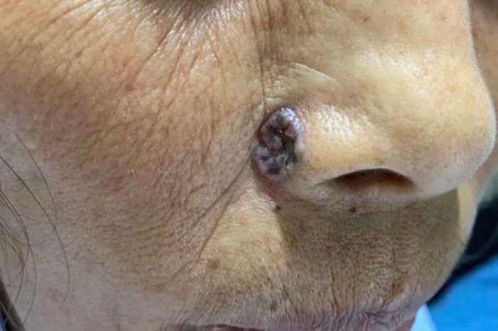 Hình ảnh một bệnh nhân bị ung thư da khám tại bệnh viện. Ảnh: BVCC.