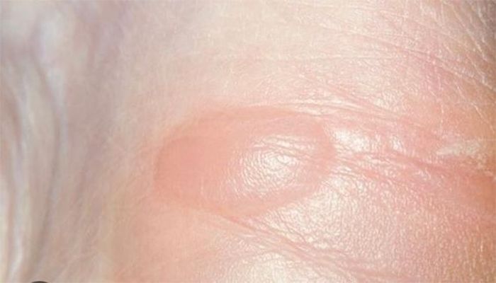 Vết bỏng trên tay Stacey Sim do sét đánh.