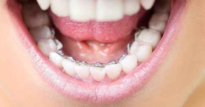 Niềng răng mắc cài mặt trong là phương pháp có tính thẩm mỹ nhất trong tất cả các cách niềng răng.