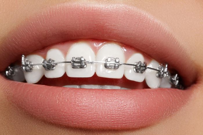Niềng răng mắc cài kim loại truyền thống phù hợp với nhiều người.