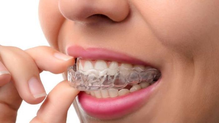 Niềng răng không mắc cài có thể tháo rời.