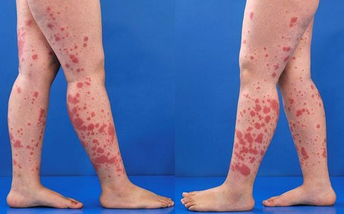 Xuất huyết dưới da - một biểu hiện của viêm mao mạch dị ứng.