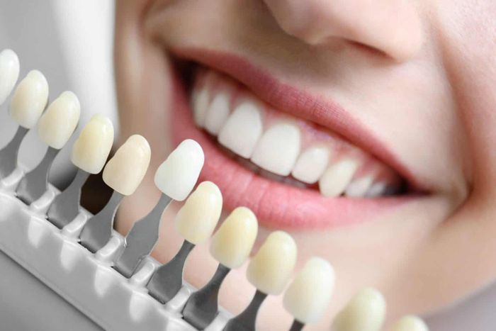 Dán sứ veneer có màu sắc tự nhiên.