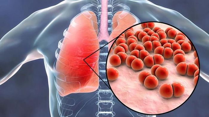 Bệnh nấm phổi nếu không phát hiện và điều trị kịp thời, tỷ lệ tử vong có thể lên tới 50-70%.