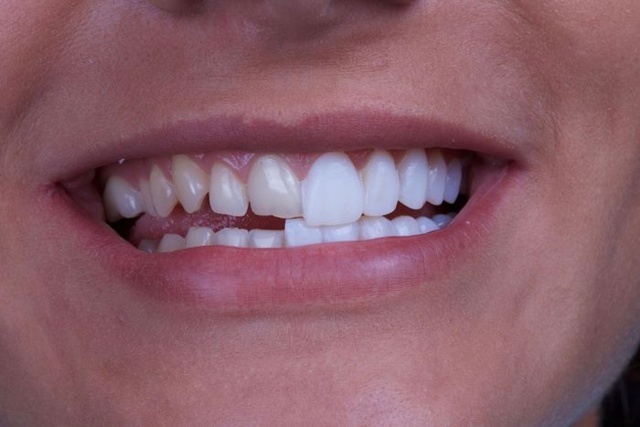 Dán sứ veneer mang lại vẻ đẹp cho hàm răng.