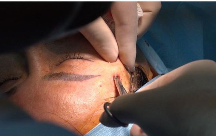 tiêm filler