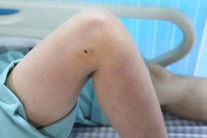 Chân bà L bị gà mổ gây sưng nề, nóng đỏ