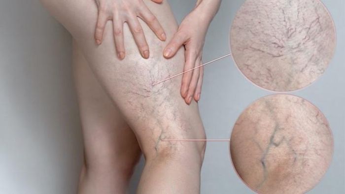 Bệnh suy giảm tĩnh mạch trở nặng có thể gây tử vong. (Ảnh minh họa)
