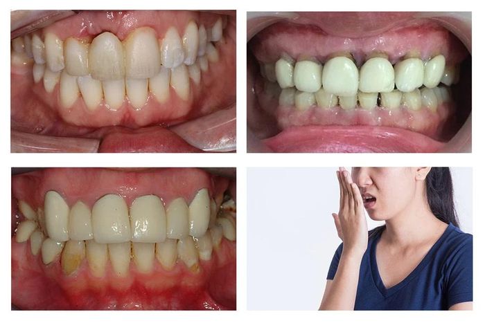  Sử dụng răng sứ kém chất lượng gây ra nhiều hệ lụy tới sức khỏe. Ảnh: ĐVCC 