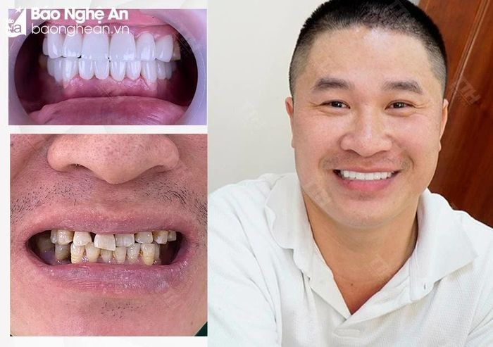  Sự thay đổi khác biệt của khách hàng sau khi thẩm mỹ răng sứ tại Bệnh viện Thái Thượng Hoàng. Ảnh ĐVCC 