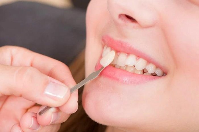  Dán sứ veneer là phương pháp giúp bảo tồn răng gốc tối đa. Ảnh: ĐVCC 