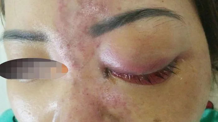 tiêm filler