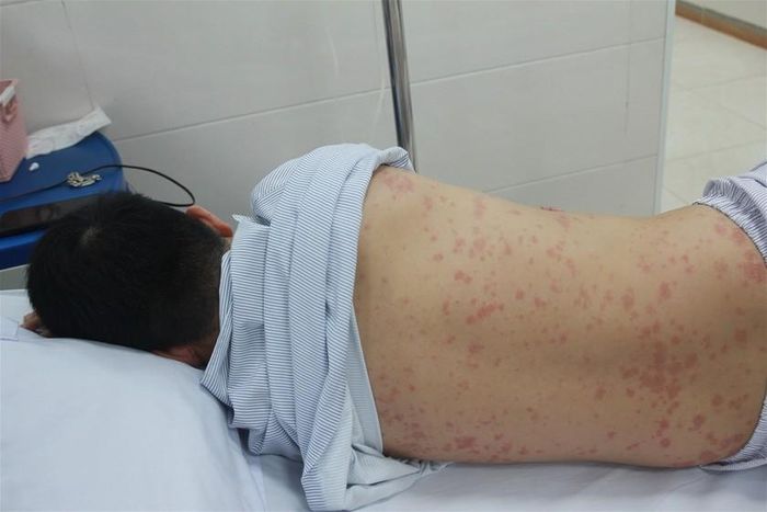 Hình ảnh xuất huyết da của một bệnh nhân mắc liên cầu lợn.