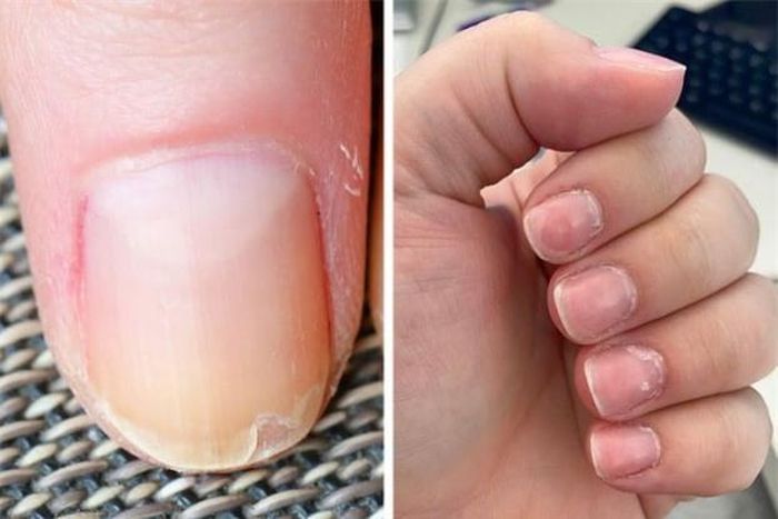 Những lý do phổ biến nhất khiến móng tay và lớp biểu bì bị bong tróc là do thiếu sắt và mất nước.
