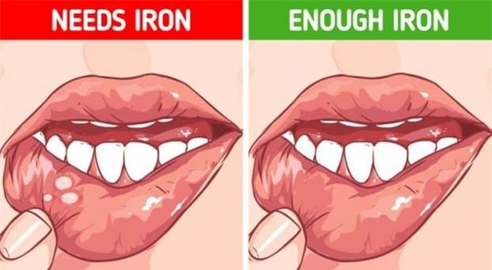 Những lý do gây lở loét miệng phổ biến nhất là hút thuốc, dị ứng, vô tình cắn vào lưỡi hay bị viêm.