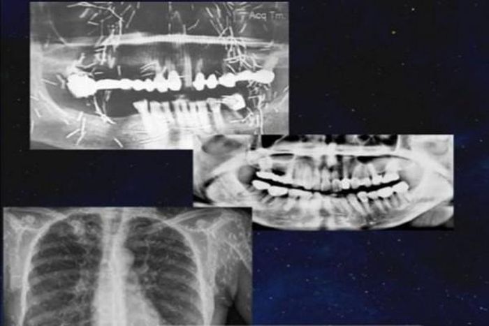 Khi kiểm tra kết quả chụp CT, máu và chụp X-quang của bệnh nhân, bác sĩ phát hiện bệnh nhân này cấy rất nhiều kim bùa vào mắt, mặt, cổ và ngực.
