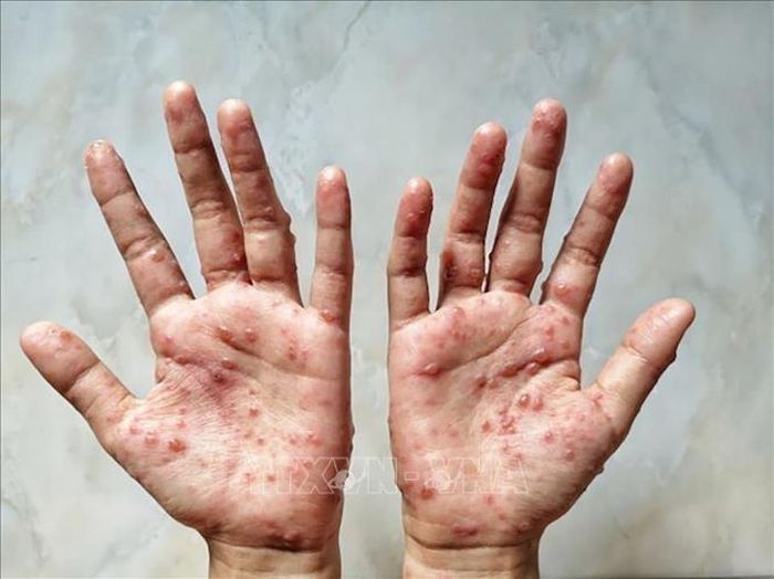 Theo định nghĩa của Tổ chức Y tế Thế giới, đậu mùa khỉ là một bệnh do virus đậu mùa khỉ gây ra. Ảnh: TTXVN