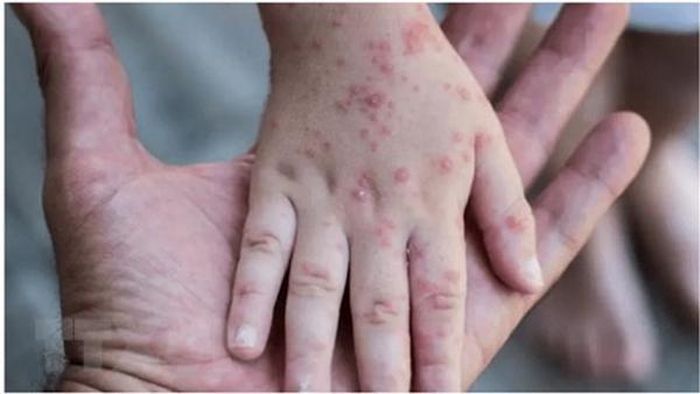 Những nốt ban đậu mùa khỉ xuất hiện trên tay người bệnh.